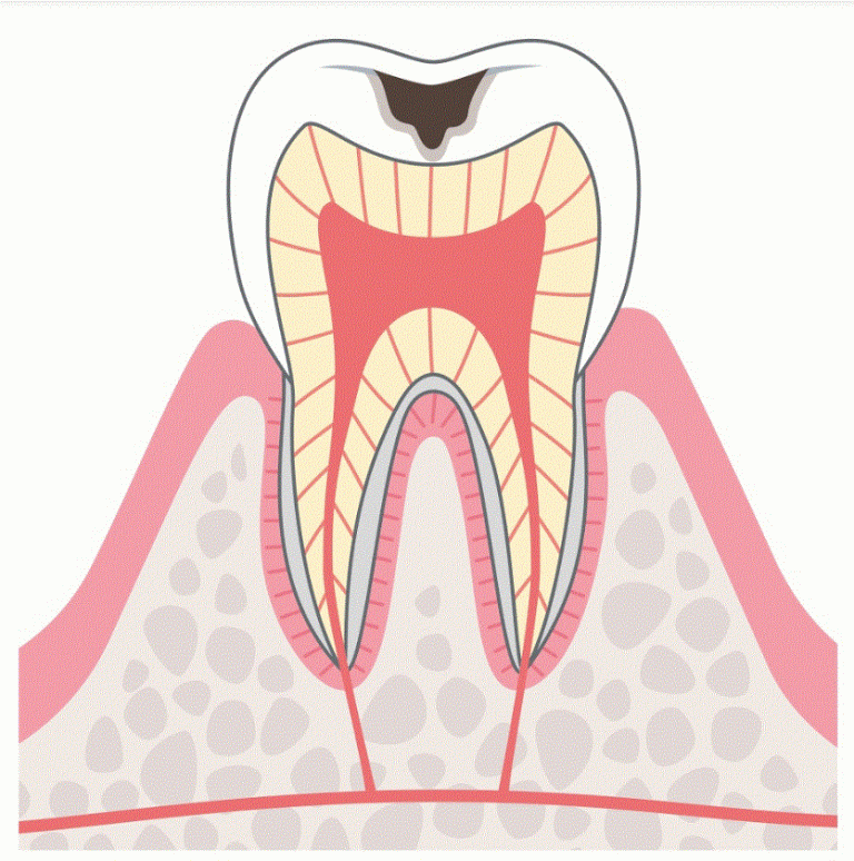 C2:象牙質の虫歯