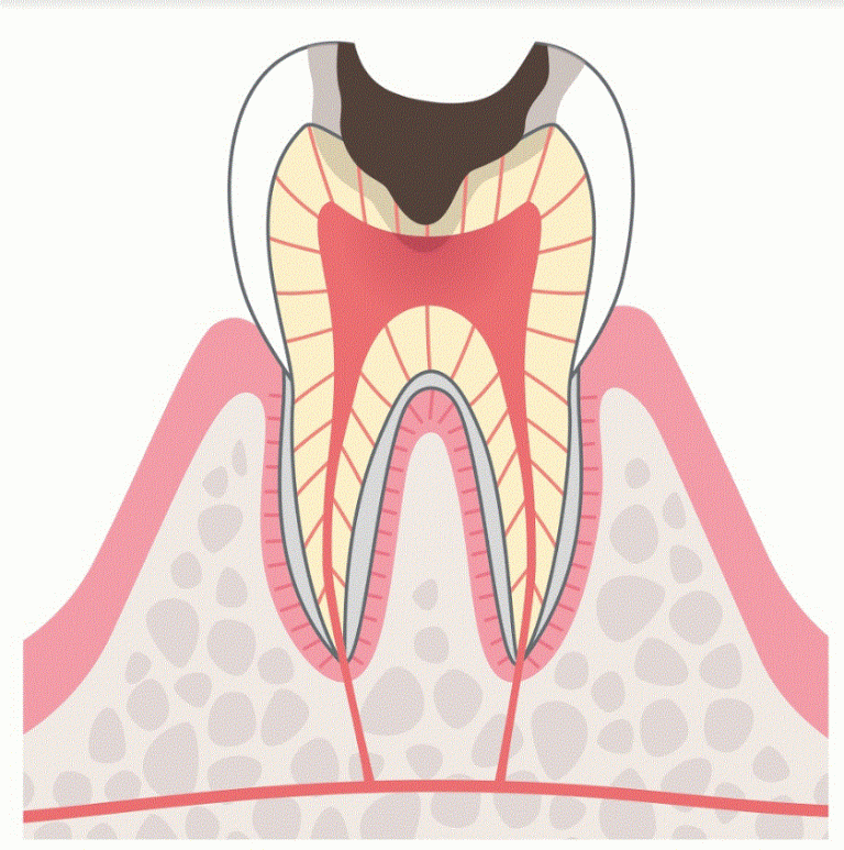 C3:神経に達した虫歯