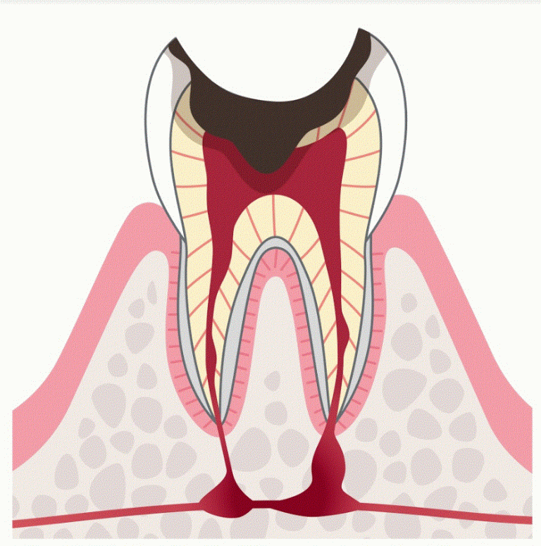 C4:歯根に達した虫歯
