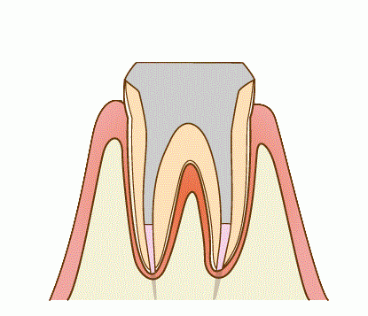 根管治療の流れ5