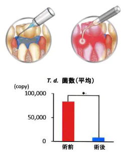 PDT光殺菌治療