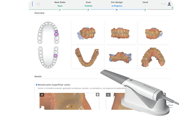 口腔内スキャナーを使用した精密で不快感の少ない最先端治療