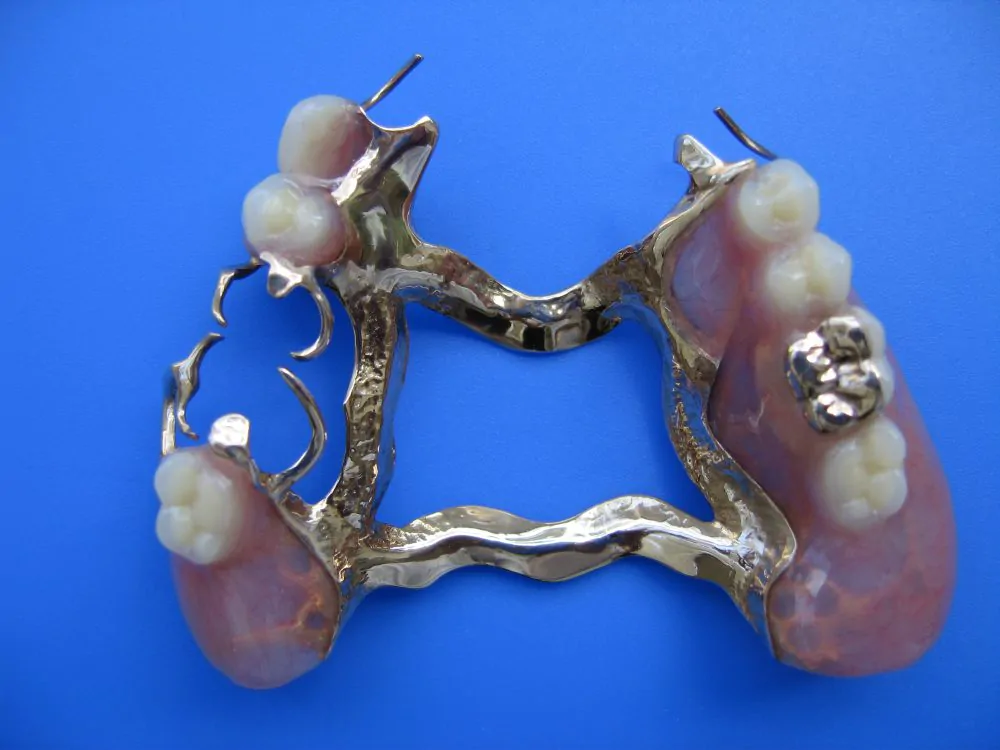 精密鋳造金属床義歯
