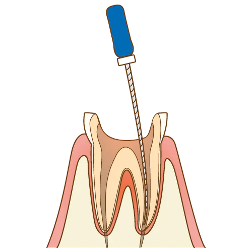 根管治療の流れ2
