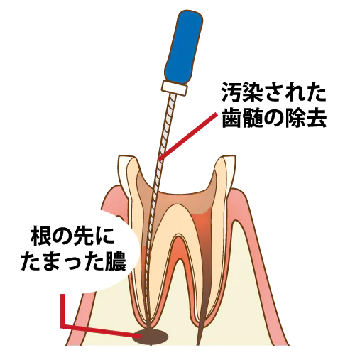 根管治療の流れ1