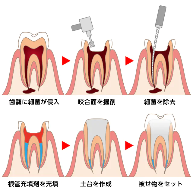 神経まで侵された重度のむし歯と、歯を守る根管治療
